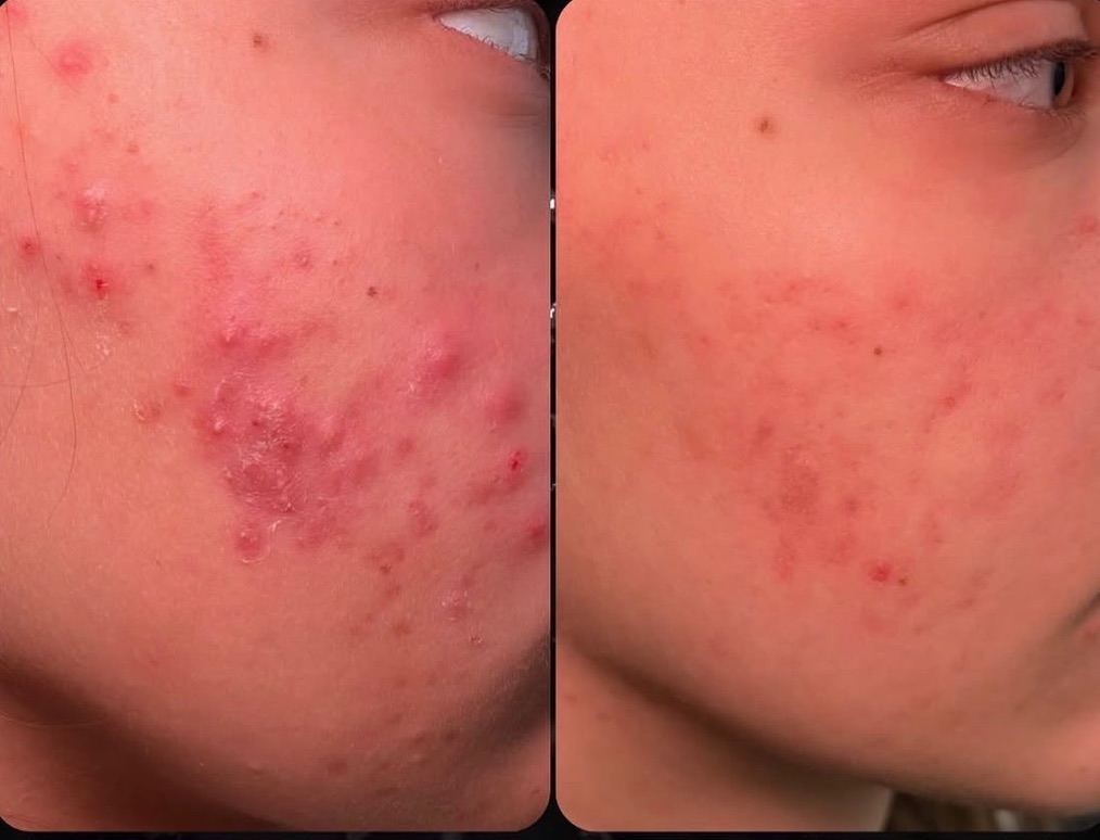 Side-by-side before and after photographs following one chemical peel and a customized skincare routine
