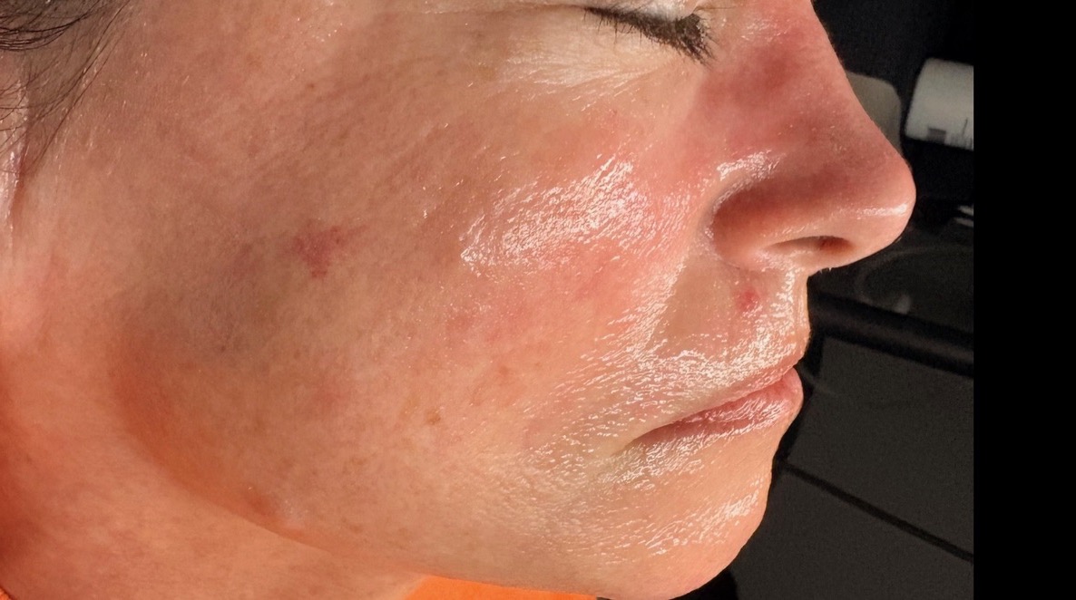 Client's skin after one custom facial