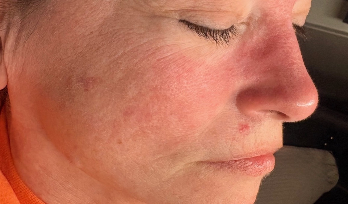 Client's skin before one custom facial